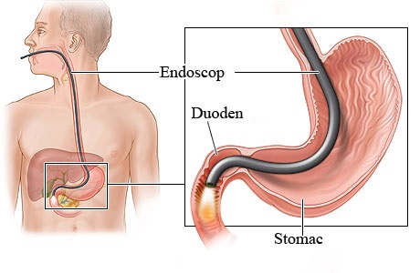 Endoscopia digestiva superioara