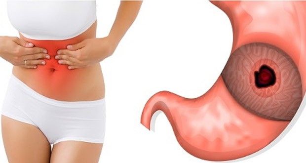Ulcerul gastroduodenal - cauze, simptome si tratament