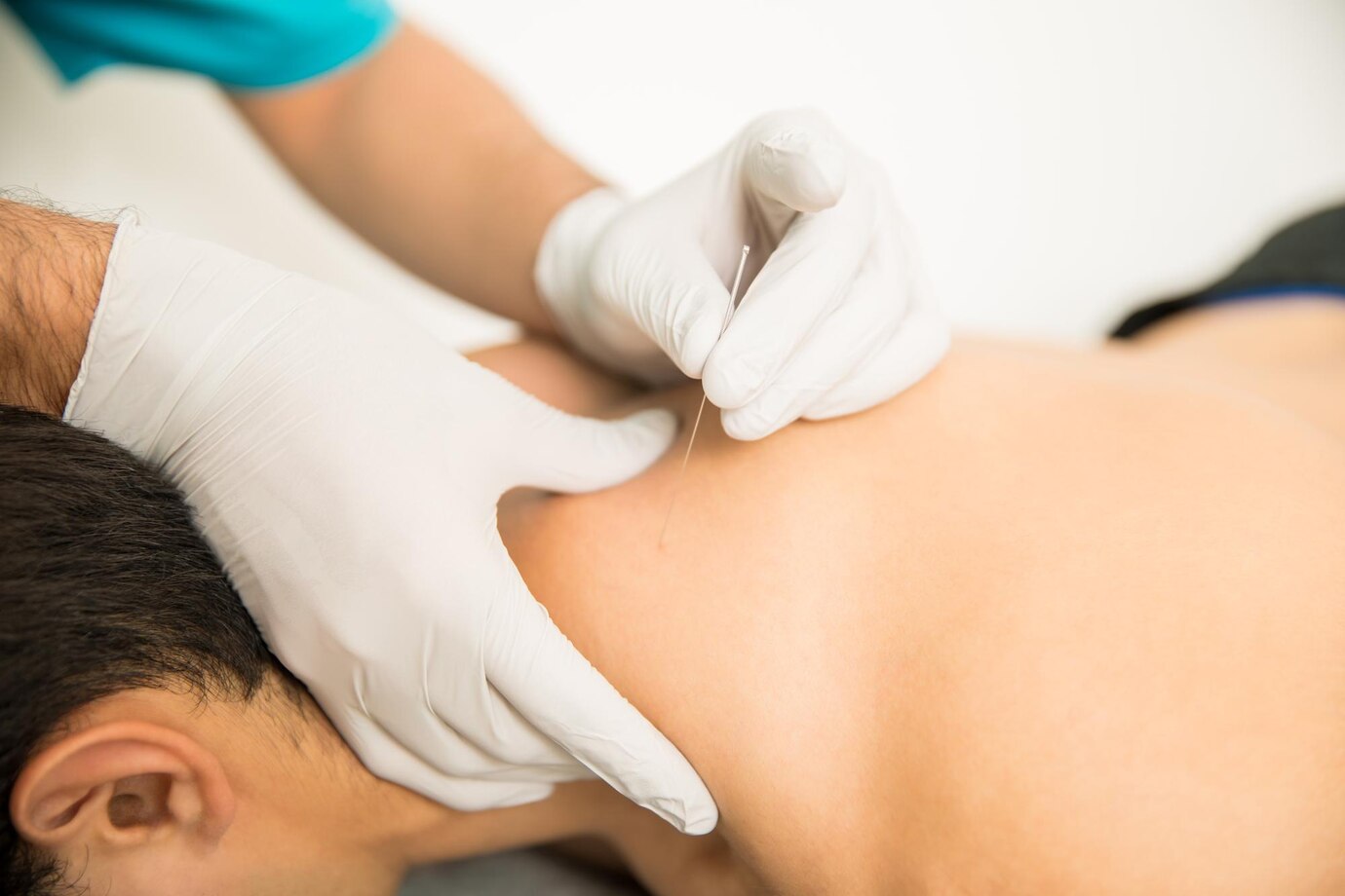 Terapia Dry Needling – Noua abordare pentru durerile cronice la Fortius Medical
